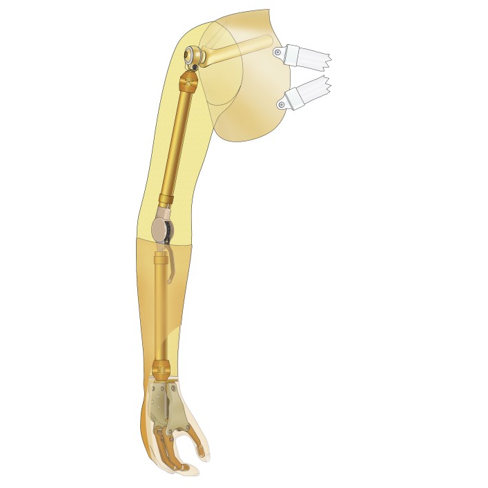 Passive arm prostheses