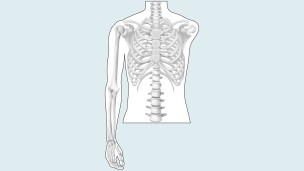 Drawing of the amputation level: shoulder disarticulation