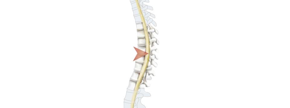 Illustration av en inkomplett ryggmärgsskada