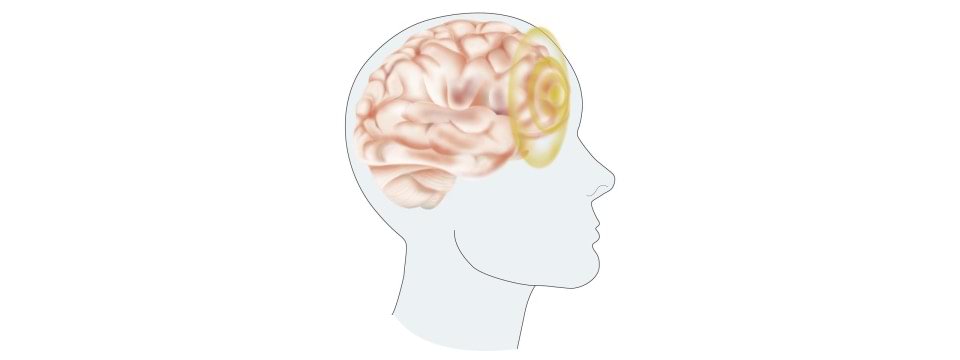 Illustration av ett hjärntrauma