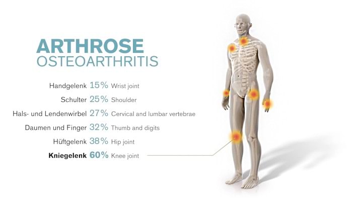 Arthrose kann in verschiedenen Gelenken auftreten. 
