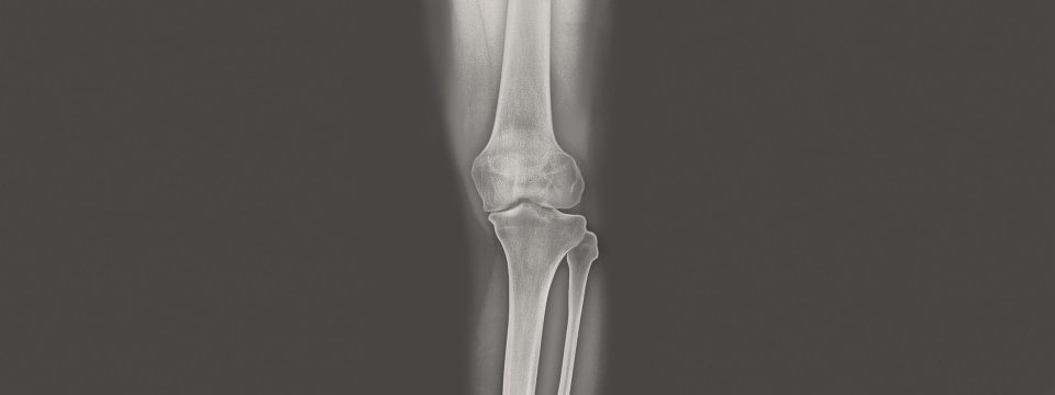 X-ray view of a knee with osteoarthritis