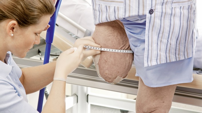 The therapist measures the residual limb circumference of a leg amputee.