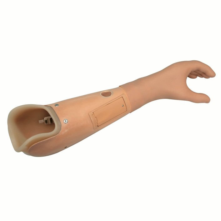 Transradial prosthesis with ThermoLyn inner socket and MyoFacil prosthetic hand