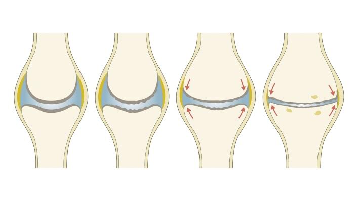Medical illustration of the progression of osteoarthritis.