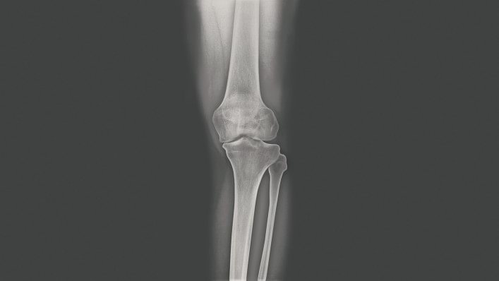 X-ray image of a knee with osteoarthritis