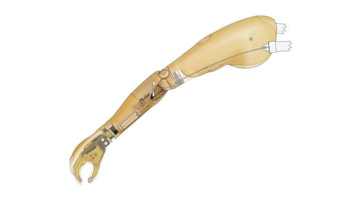 Body powered elbow with myoelectric forearm prosthesis and myoelectric hand.