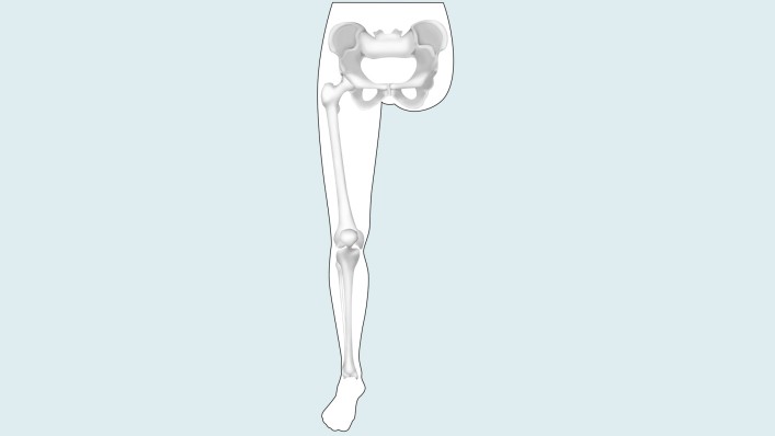 Drawing of the amputation level: hip disarticulation