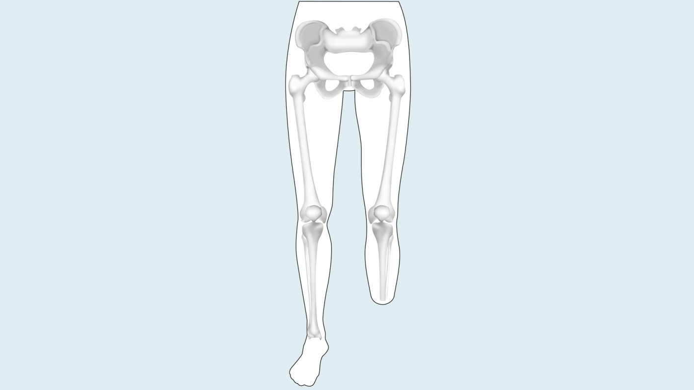 Information For Lower Limb Amputees And Their Families | Ottobock US