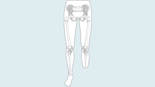 Drawing of the amputation level: lower leg