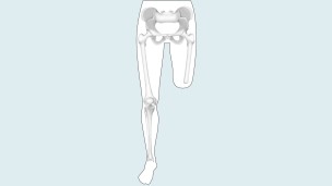 Drawing of the amputation level: upper leg