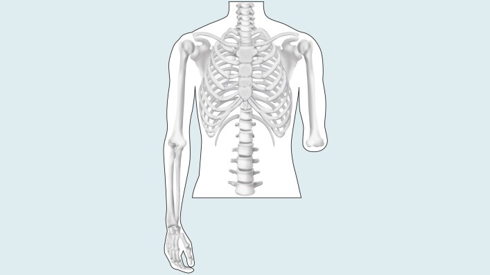 Drawing of the amputation level: elbow disarticulation