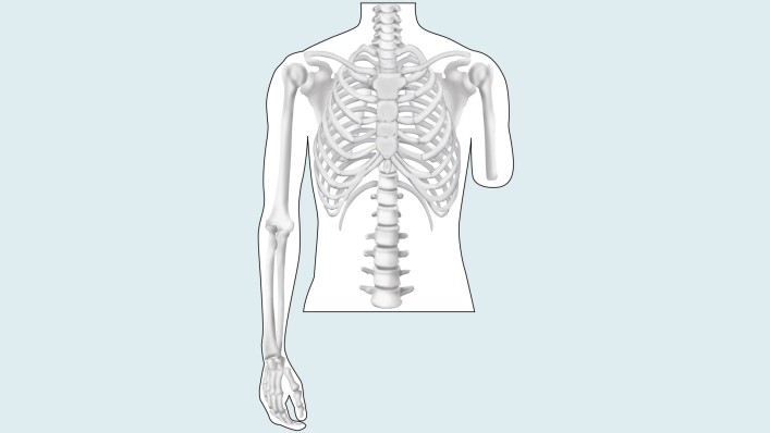 Drawing of the amputation level: upper arm